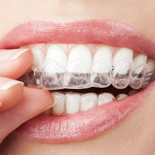 Unleash The Power Of Invisible Braces: A Guide To The Perfect Smile